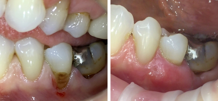 před a po - plastika dásně