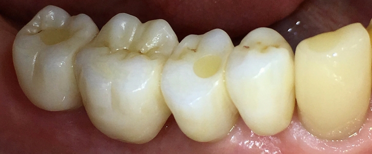 technologie implantace zubu