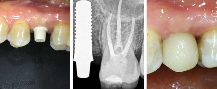 zavedení zubního implantátu