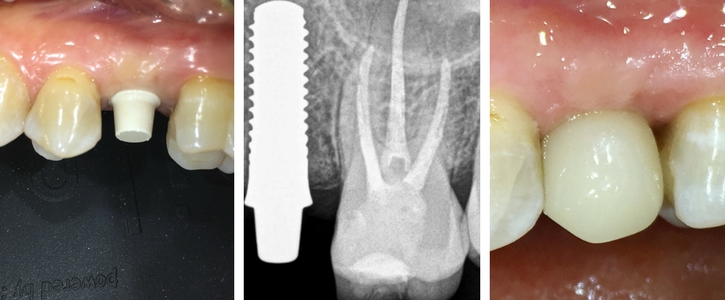 aplikace bílého implantátu