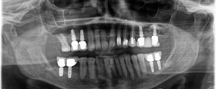 rentgen zubních implantátu